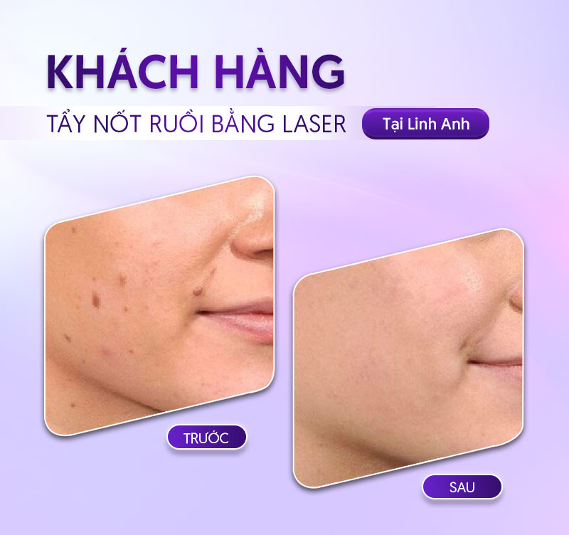 giá tẩy nốt ruồi bằng laser giá tẩy nốt ruồi bằng laser