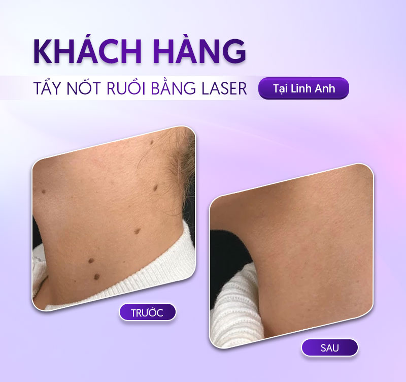 giá tẩy nốt ruồi giá tẩy nốt ruồi