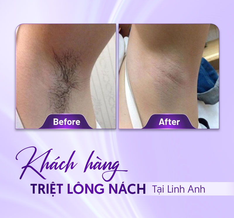 giá triệt lông nách giá triệt lông nách