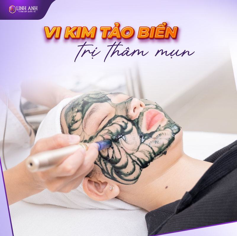 thâm đỏ sau mụn giảm thâm mụn đỏ