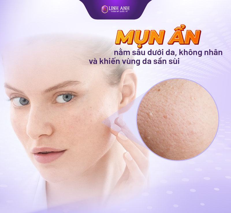 các loại mụn thường gặp hình ảnh các loại mụn
