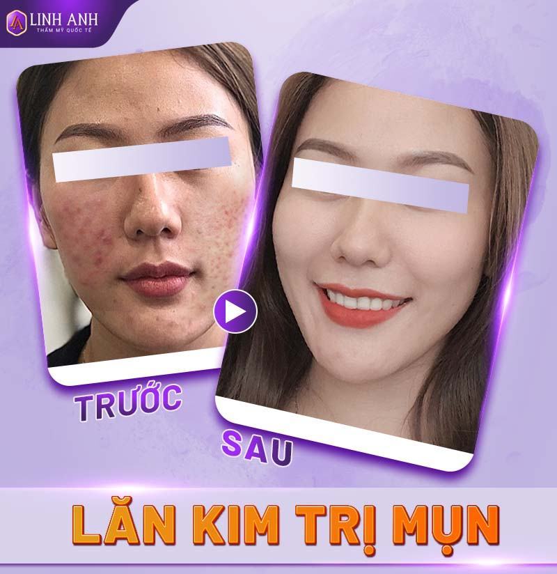 lăn kim trị mụn có tốt không - Thẩm mỹ Quốc tế Linh Anh hình ảnh lăn kim trị mụn