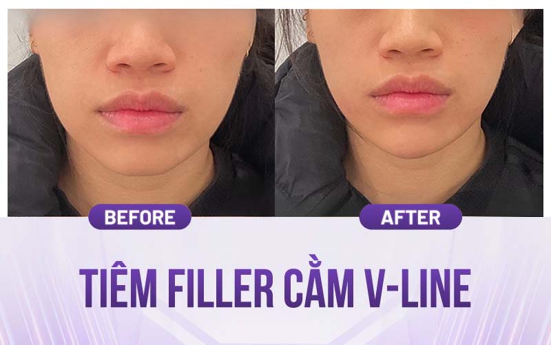 Hình ảnh sau tiêm filler cằm chẻ