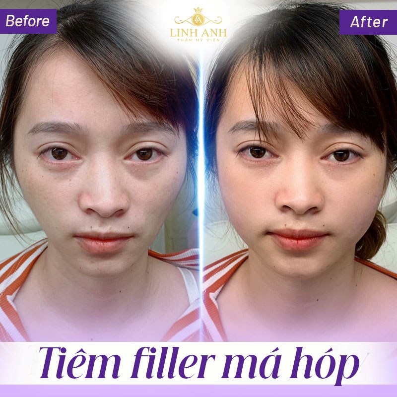 Hình ảnh tiêm má baby