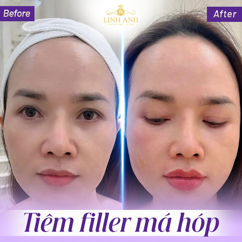 Hình ảnh tiêm má hóp