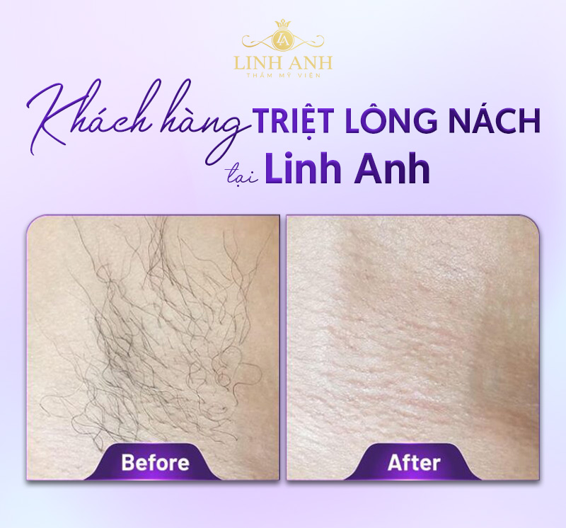 Hình ảnh triệt lông nách Diode laser