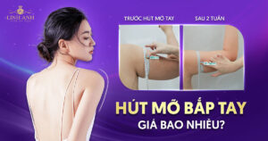 hút mỡ bắp tay bao nhiêu tiền