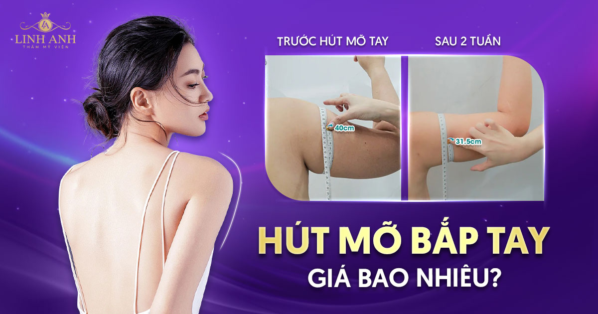 hút mỡ bắp tay bao nhiêu tiền