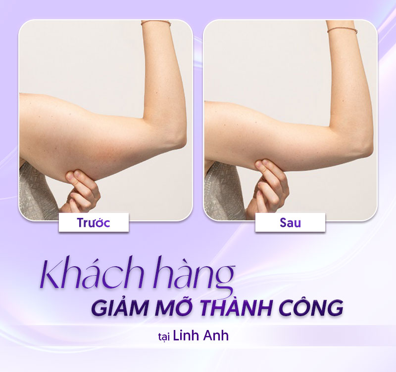 hút mỡ bắp tay hết bao nhiêu tiền hút mỡ bắp tay hết bao nhiêu tiền