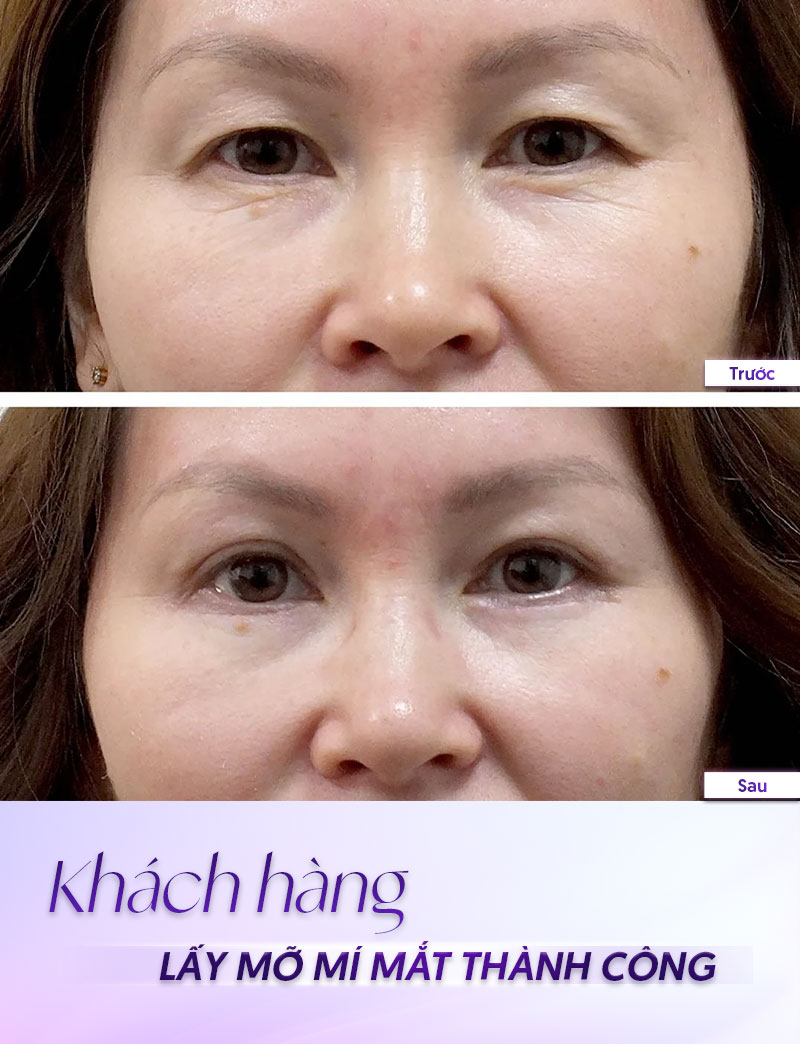 hút mỡ mắt trên bao nhiêu tiền hút mỡ mắt trên bao nhiêu tiền