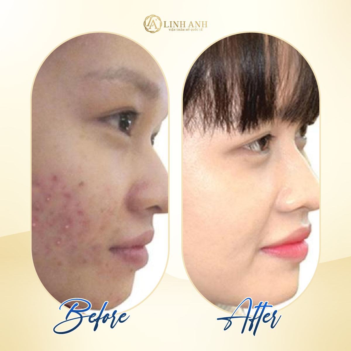 có nên trị mụn đầu đen bằng kem đánh răng kem đánh răng trị mụn đầu đen - Viện thẩm mỹ quốc tế Linh Anh