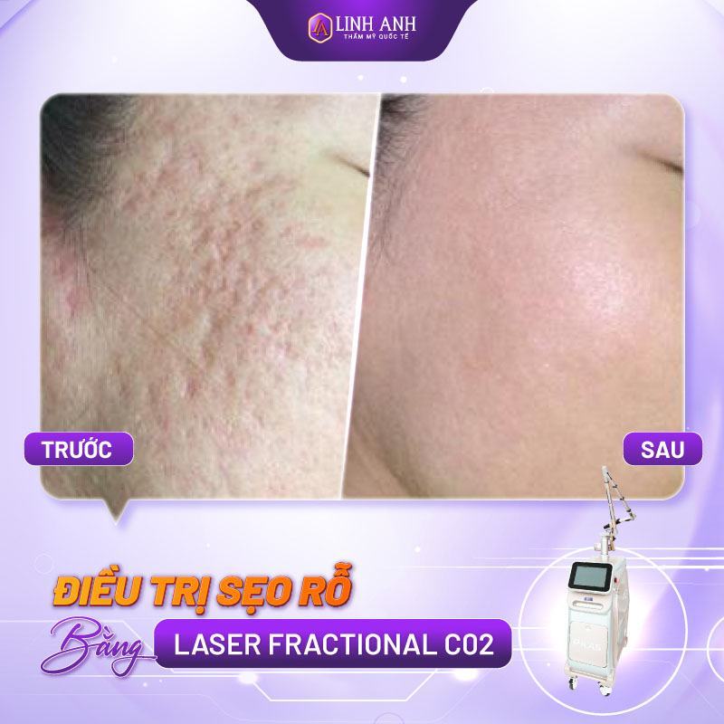 kem mờ sẹo rỗ