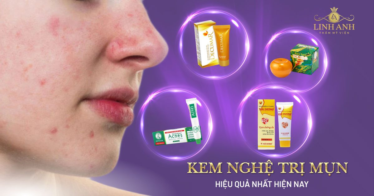 kem nghệ trị mụn