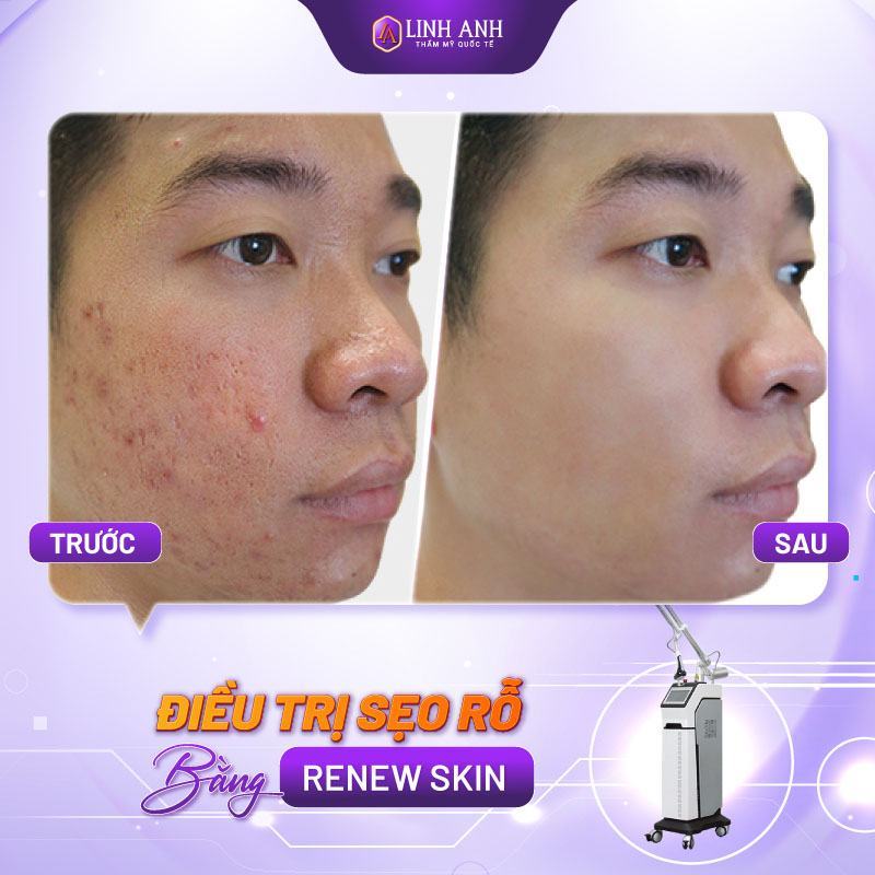 kem trị sẹo rỗ đông y
