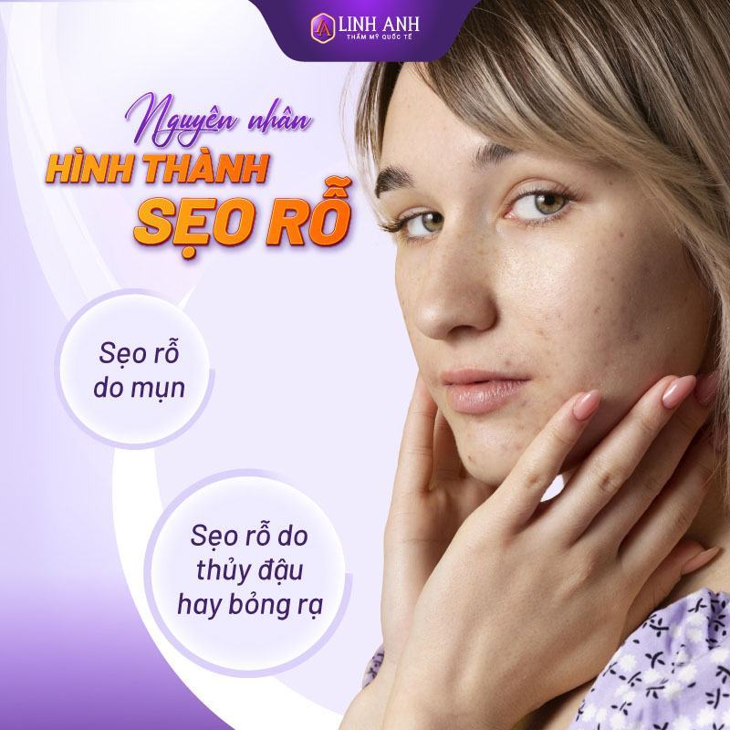 kem trị sẹo rỗ lâu năm
