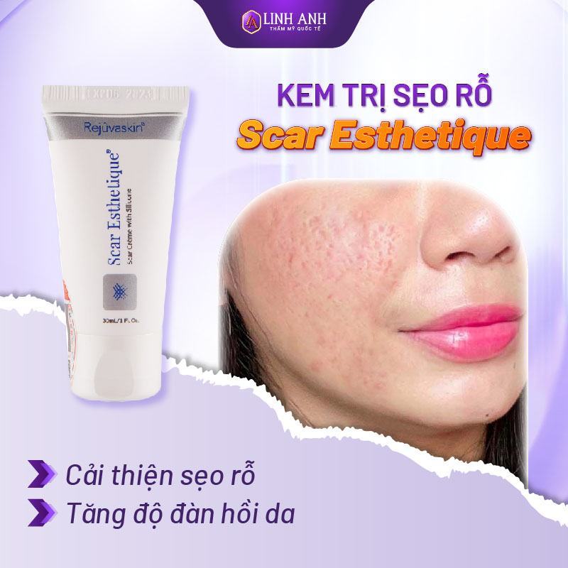 kem trị sẹo rỗ tại nhà