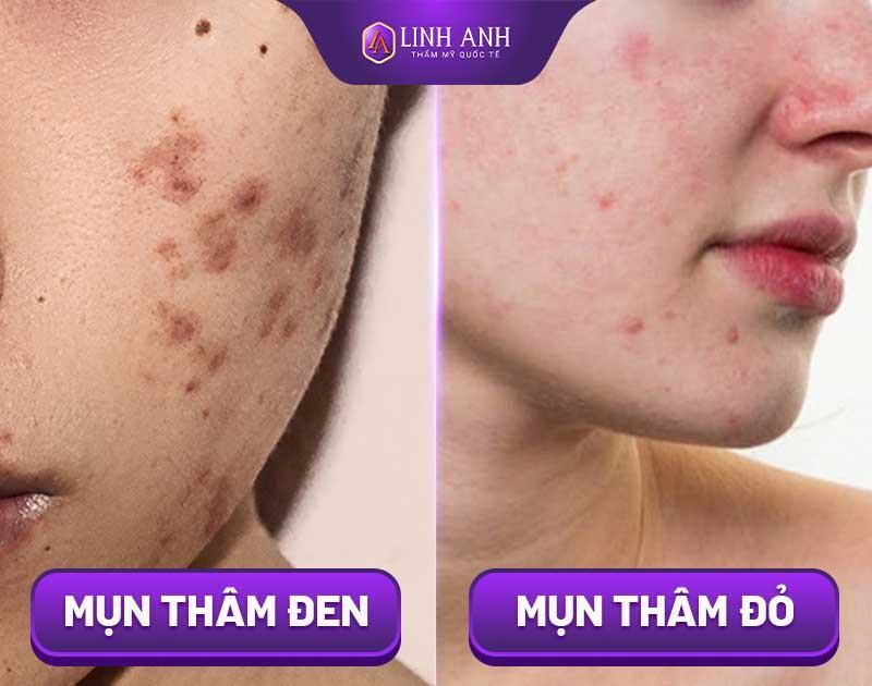 kem trị thâm mụn kem trị thâm mụn tốt nhất