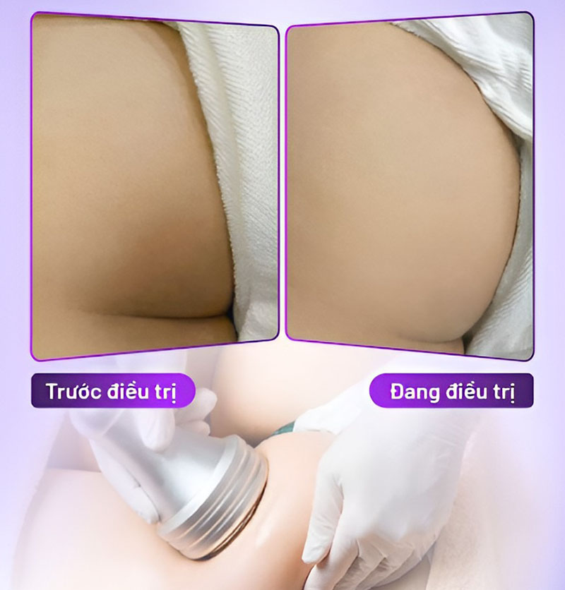 khử thâm mông giá bao nhiêu khử thâm mông giá bao nhiêu