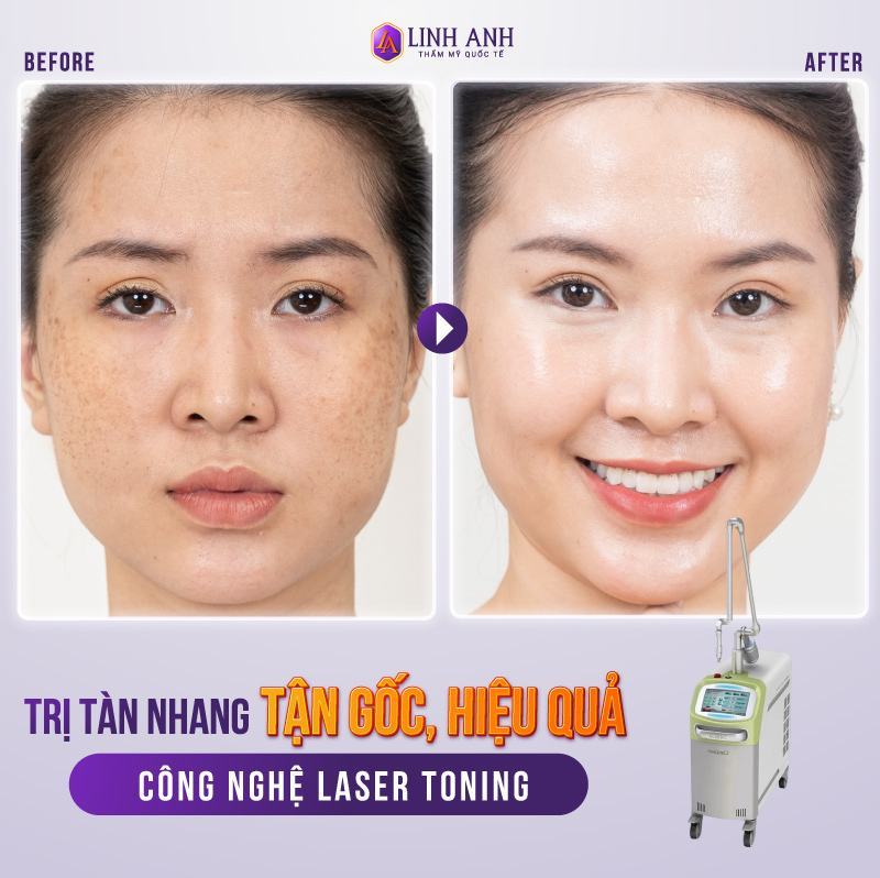 cách trị tàn nhang bằng lá tía tô lá tía tô để điều trị tàn nhang
