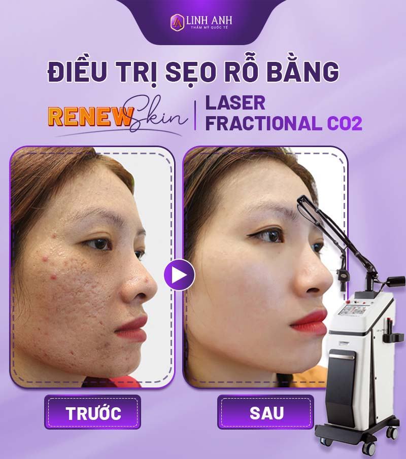 cách trị sẹo rỗ dân gian làm cách nào để trị sẹo rỗ