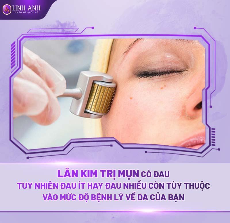 có nên lăn kim trị mụn - Thẩm mỹ Quốc tế Linh Anh lăn kim trị mụn có đau không
