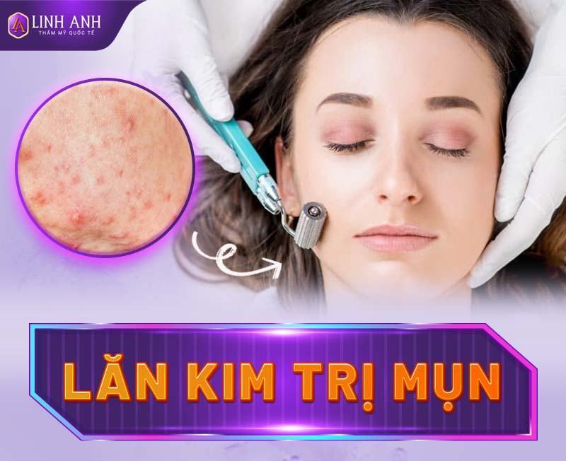 lăn kim trị mụn - Thẩm mỹ Quốc tế Linh Anh lăn kim trị mụn có tốt không