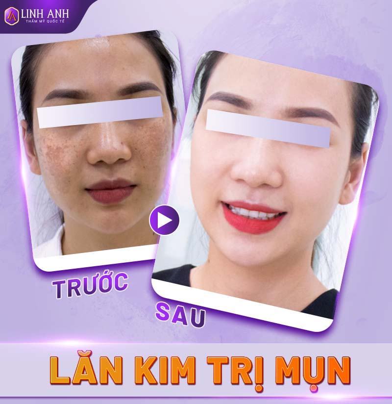 lăn kim trị mụn - Thẩm mỹ Quốc tế Linh Anh lăn kim trị mụn là gì