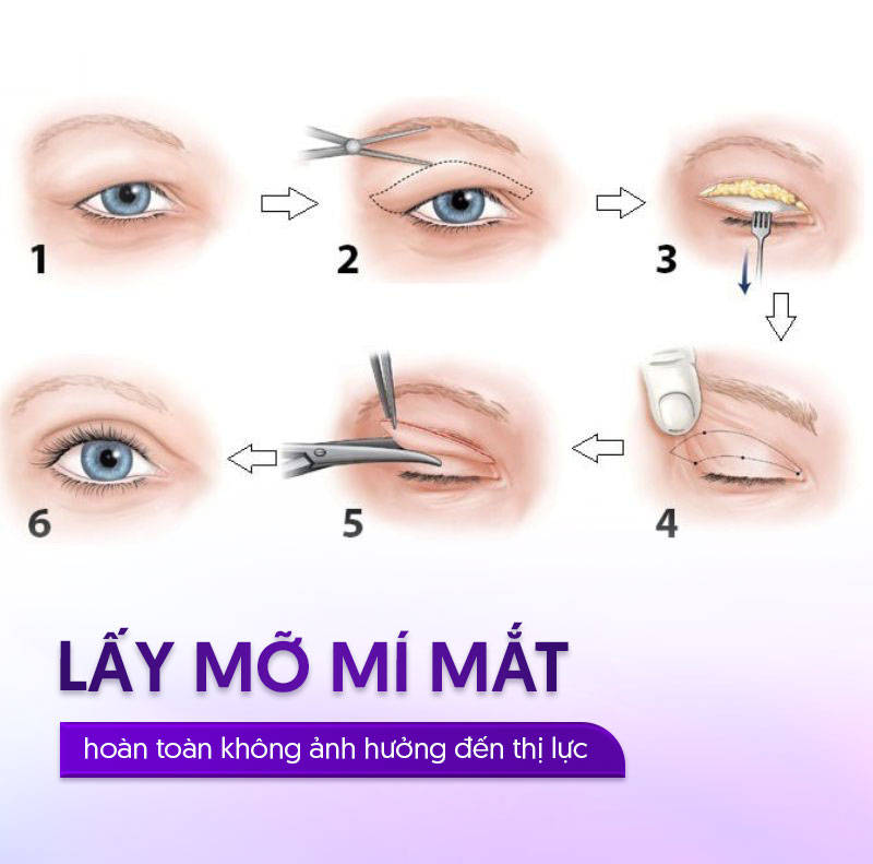 lấy mỡ mí mắt trên bao nhiêu tiền lấy mỡ mí mắt trên bao nhiêu tiền