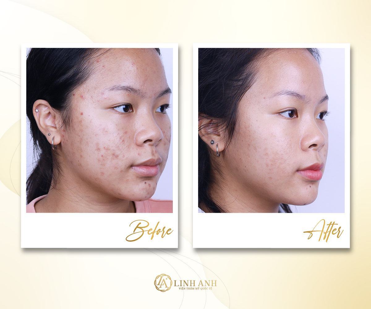 ăn mận có bị nổi mụn không mận ăn nhiều có nổi mụn không - Viện thẩm mỹ quốc tế Linh Anh