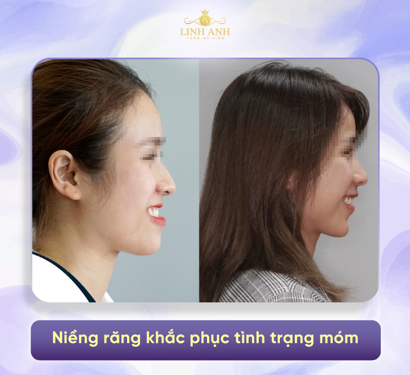 miệng móm có nên niềng răng