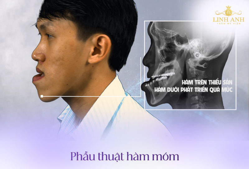 miệng móm là gì