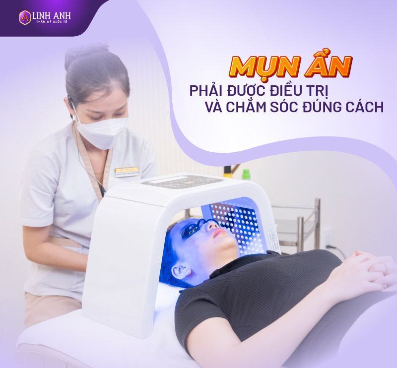 mụn ẩn có nên nặn không mụn ẩn có nên nặn không