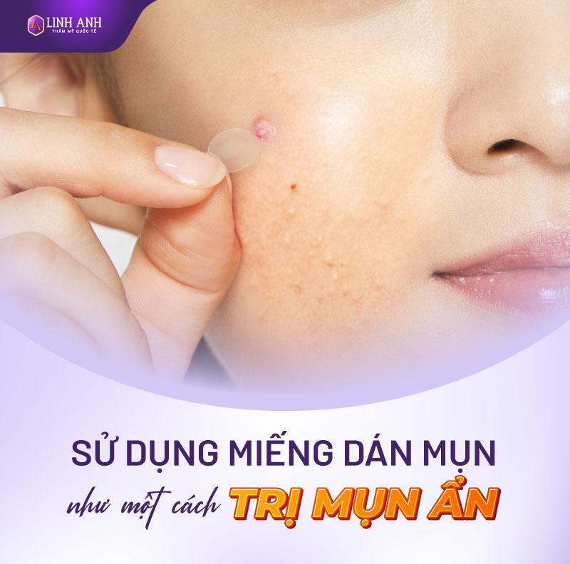 mụn ẩn có nên nặn không mụn ẩn đẩy lên có nên nặn không