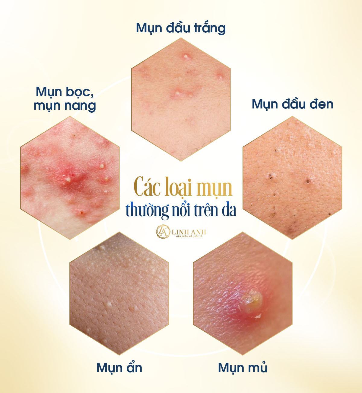 mụn có tự hết không mụn có tự hết hay không - Thẫm mỹ Quốc tế Linh Anh
