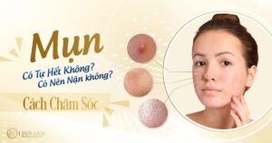 mụn có tự hết không - Thẫm mỹ Quốc tế Linh Anh
