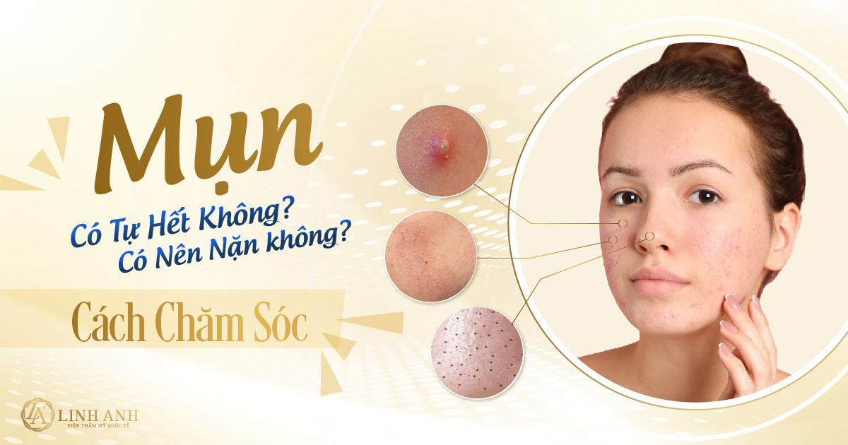 mụn có tự hết không - Thẫm mỹ Quốc tế Linh Anh
