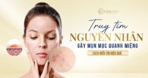 mụn mọc quanh miệng - Viện thẩm mỹ quốc tế Linh Anh