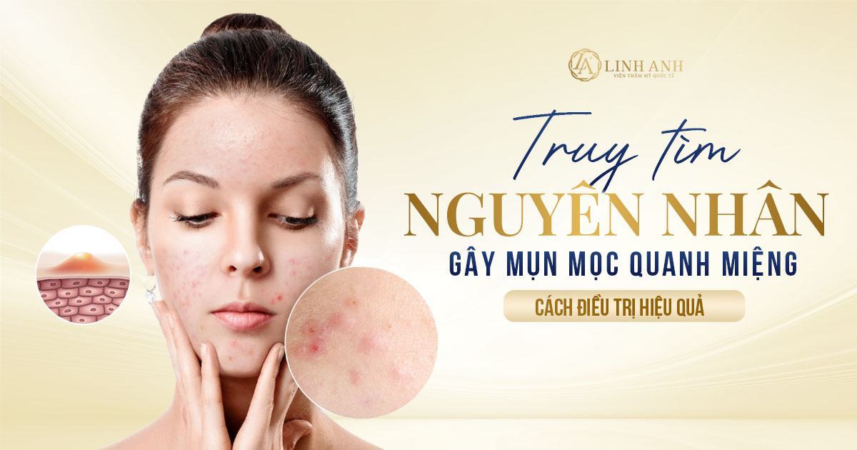 mụn mọc quanh miệng - Viện thẩm mỹ quốc tế Linh Anh