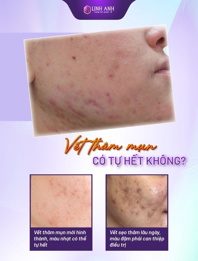 thâm mụn bao lâu thì hết mụn thâm bao lâu thì hết