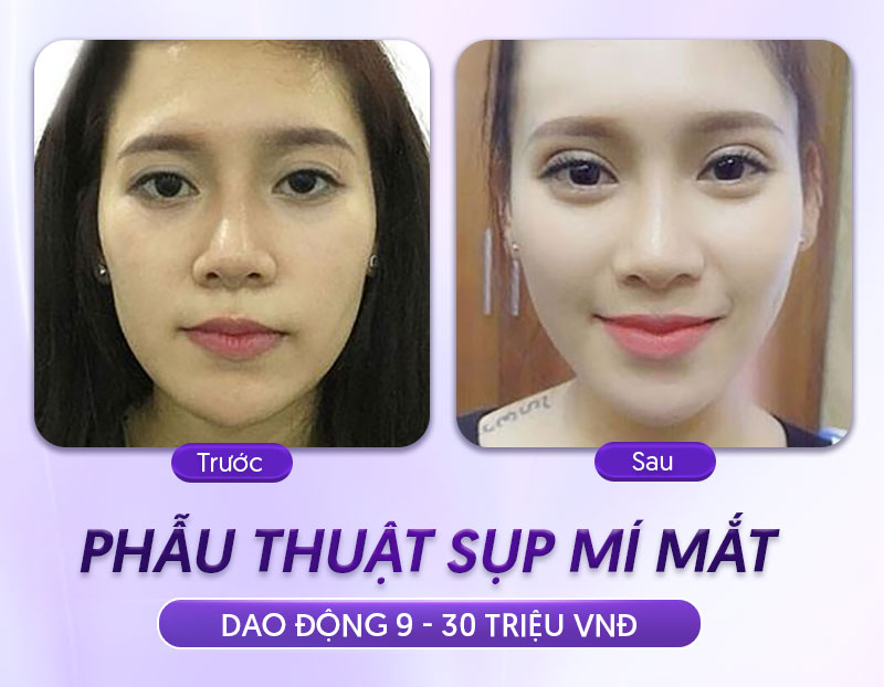 nâng cơ mí mắt giá bao nhiêu nâng cơ mí mắt giá bao nhiêu