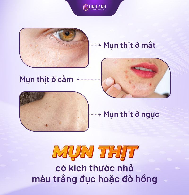 phân biệt các loại mụn nhận biết các loại mụn