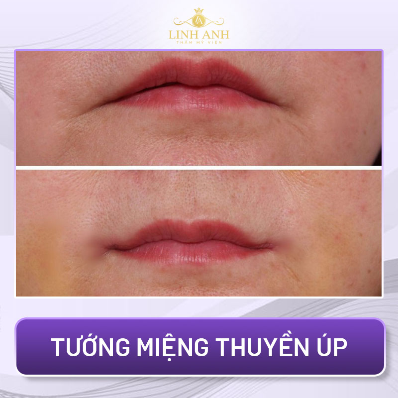 những tướng miệng xấu của phụ nữ