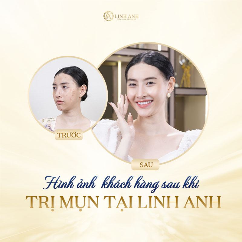 nổi mụn khi mang thai là con trai hay gái - Viện thẩm mỹ quốc tế Linh Anh nổi mụn khi mang thai là con trai hay gái - Viện thẩm mỹ quốc tế Linh Anh