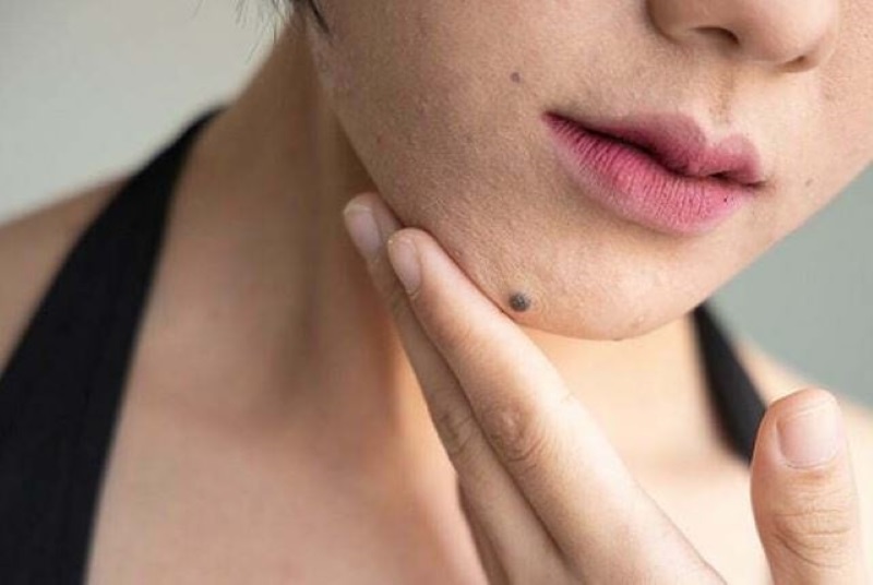 Nốt ruồi dưới cằm Nữ bên phải