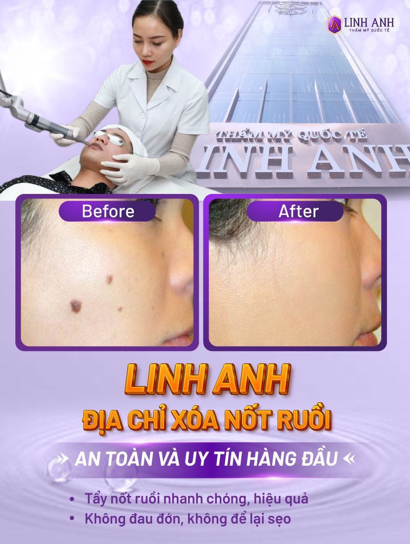 nốt ruồi dưới cằm ở nam nữ nốt ruồi dưới cằm ở nam nữ