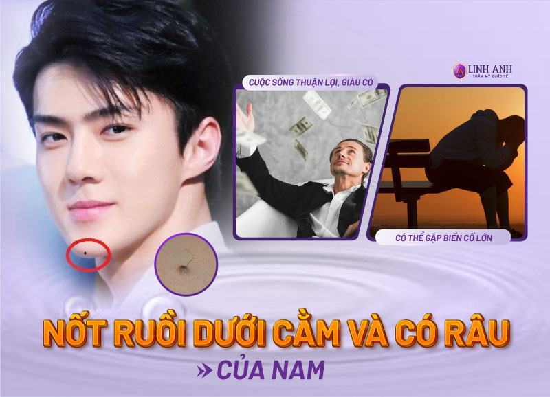 nốt ruồi ở cằm nốt ruồi ở cằm