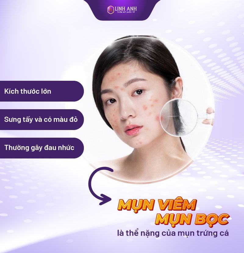 cách phân biệt các loại mụn phân biệt các loại mụn thường gặp