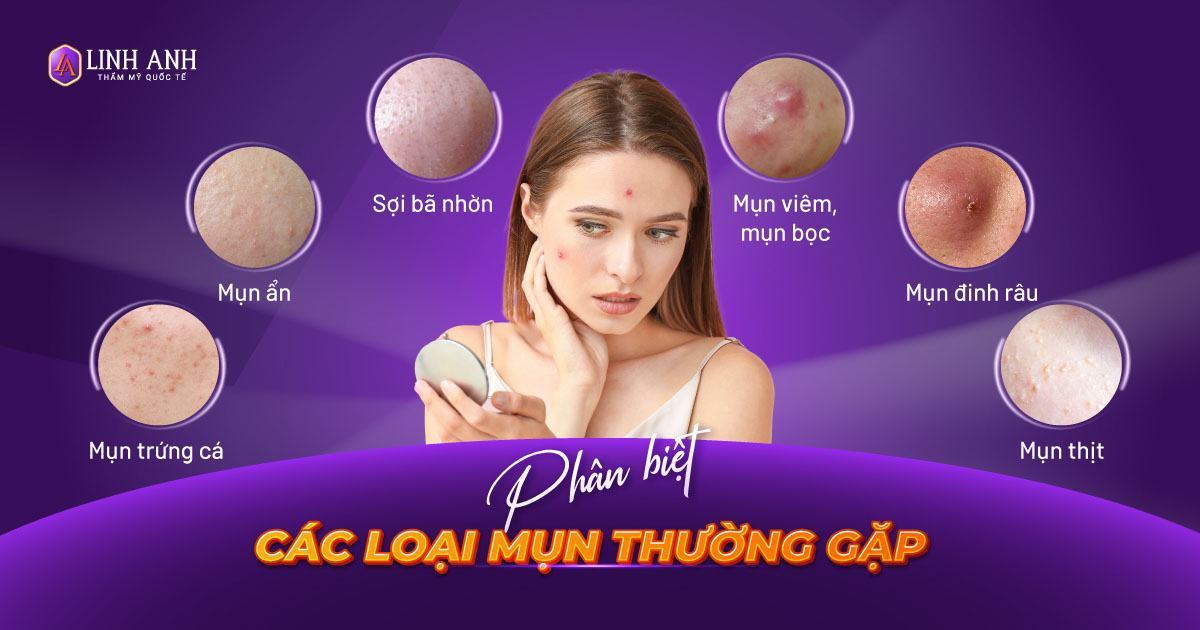 phân biệt các loại mụn
