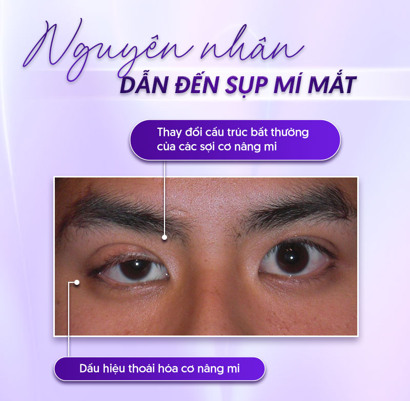 phẫu thuật sụp mí mắt giá bao nhiêu phẫu thuật sụp mí mắt giá bao nhiêu