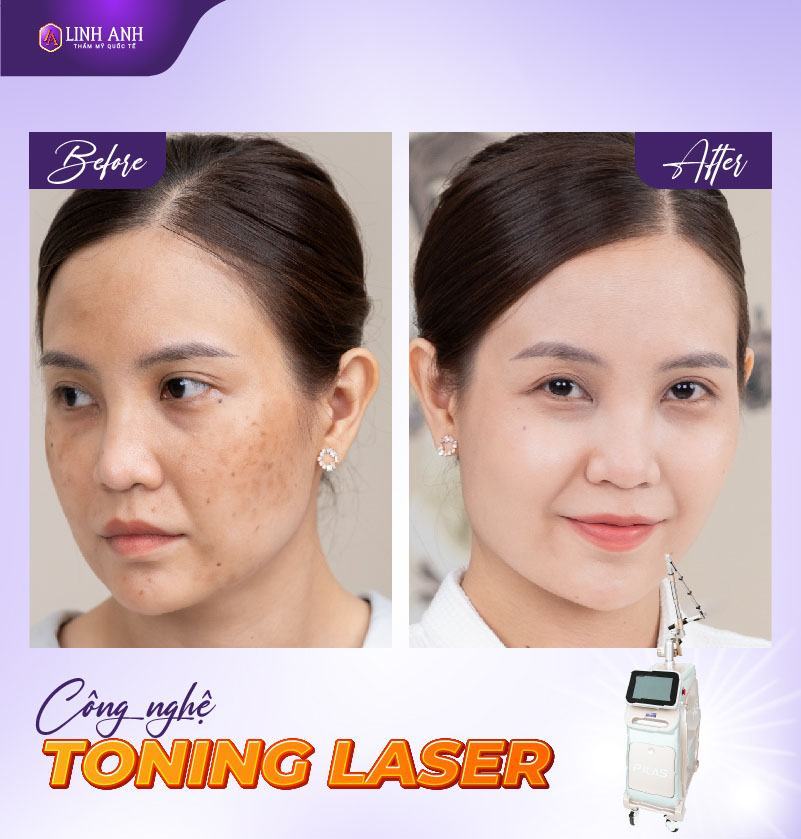 điều trị nám bằng phi kim có tốt không - Viện thẩm mỹ Quốc tế Linh Anh phi kim trị nám có hiệu quả